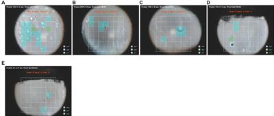 The utility of software-detected non-invasive tear break-up in comparison to fluorescein tear break-up measurements